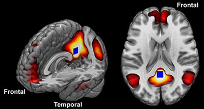 Differences in Cortical Structure and Functional MRI Connectivity in High Functioning Autism